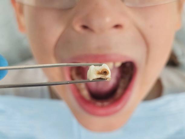 Best Emergency Broken Tooth Repair in Csar Chvez, TX